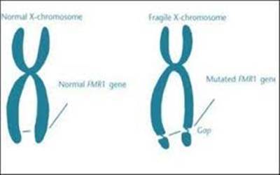 Fragile X Chromosome20170218175825_l